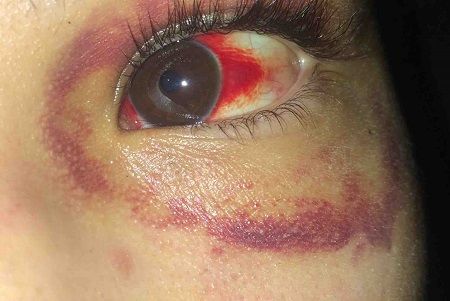 Geneva Ayala Eye injuries