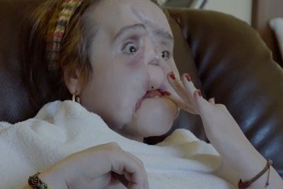Katie Stubblefield Wiki, Age, Family, Face Transplant, Bio, Height, Weight & Profile 4 Katie Stubblefield Wiki, Age, Family, Face Transplant, Height, Weight, Ethnicity