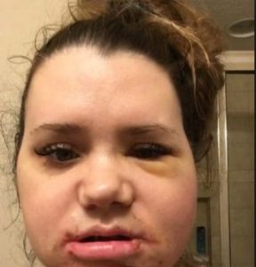 Lijana Wallenda Wiki, Age (Nik Wallenda’s Sister) Height, Bio & Family 7 Lijana Wallenda face after injuries