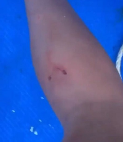 Georgia Harrison was bitten by monkey