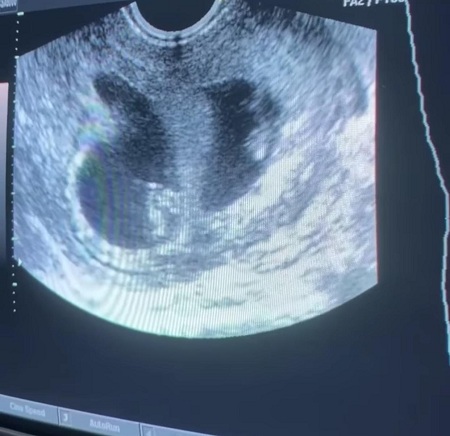 Abby De La Rosa Wiki | Age, Husband, Net worth, Family, Biography & More 10 Abby De La Rosa's Ultrasound Image