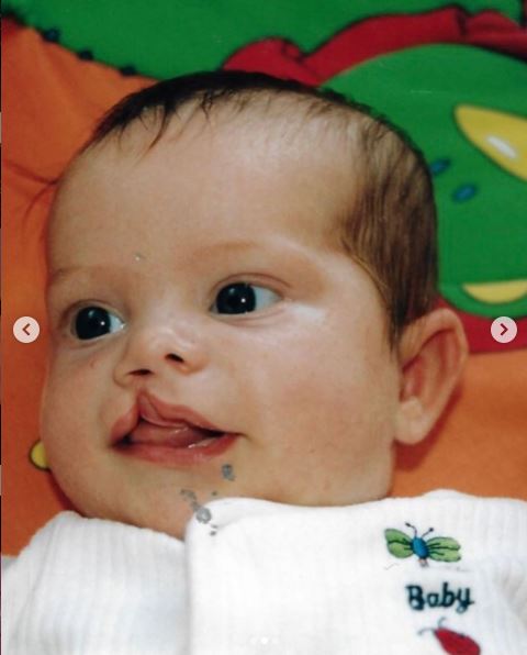 Jenny Richardson's childhood image of cleft lips