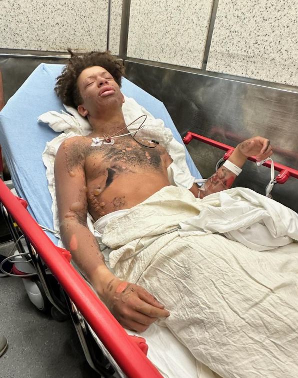 Mason Dark (TikToker) Biography, Wiki, Age, Parents, GoFundMe, Girlfriend, Video & More 3 Mason Dark burnt